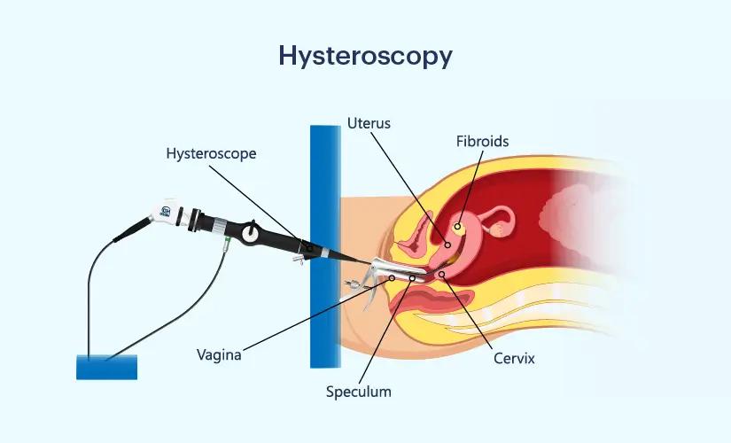 Hysteroscopy