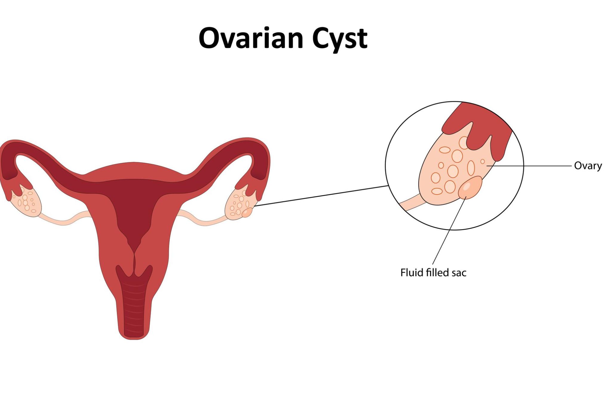 Ovarian-Cysts