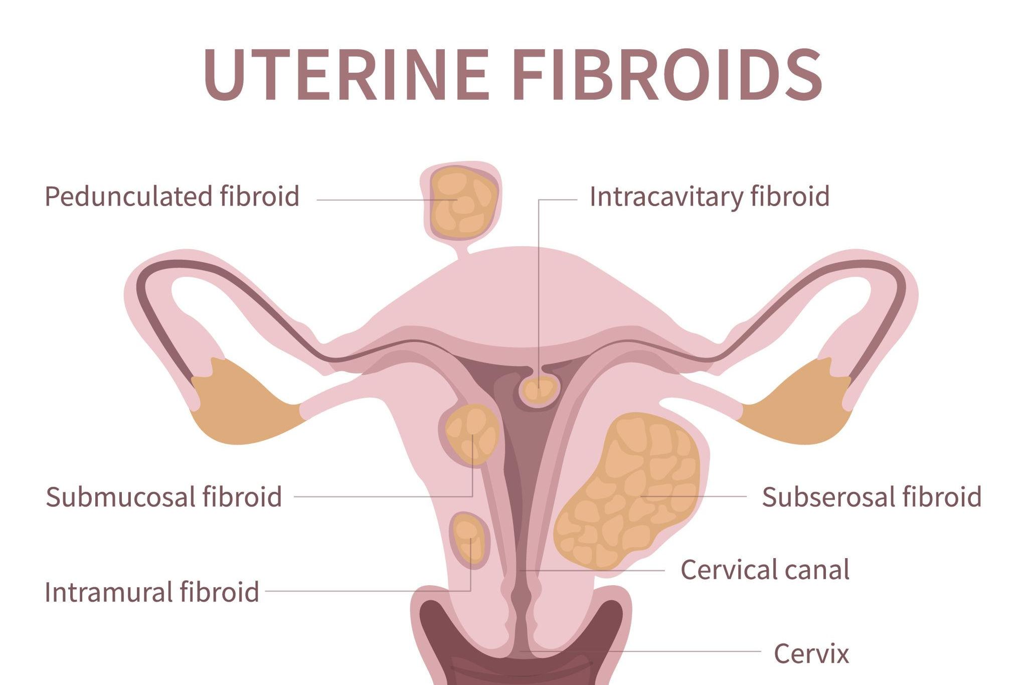 Fibroids